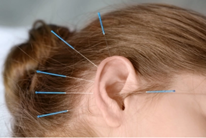 acupuntura auricular